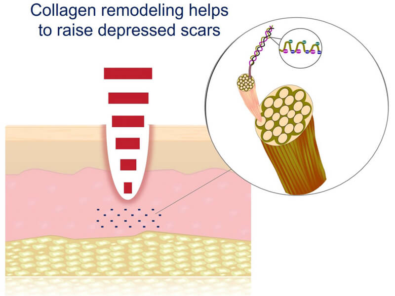 picosecond laser treatment