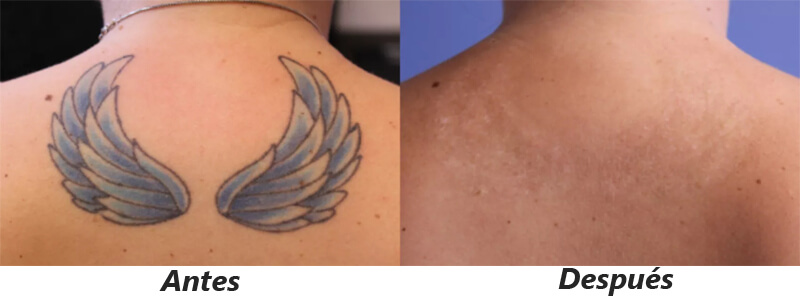 picosecond laser treatment before and after