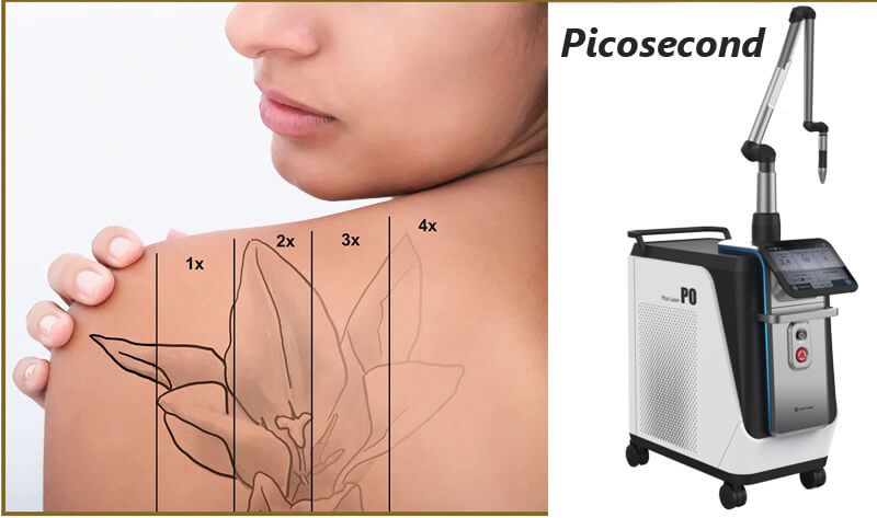 picosecond laser tattoo removal machine