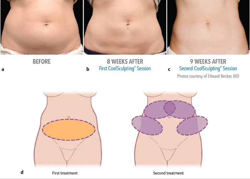 cryolipolysis treatment