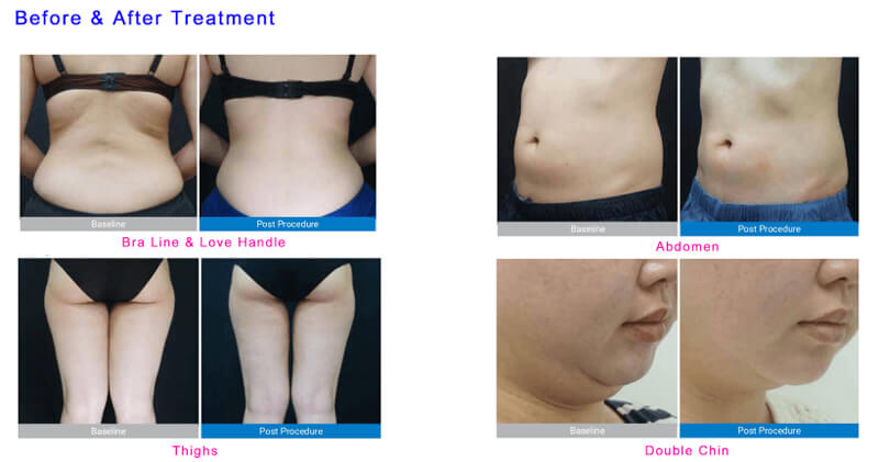 cryolipolysis treatment