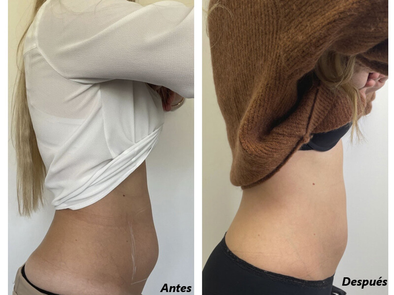 cryolipolysis treatment