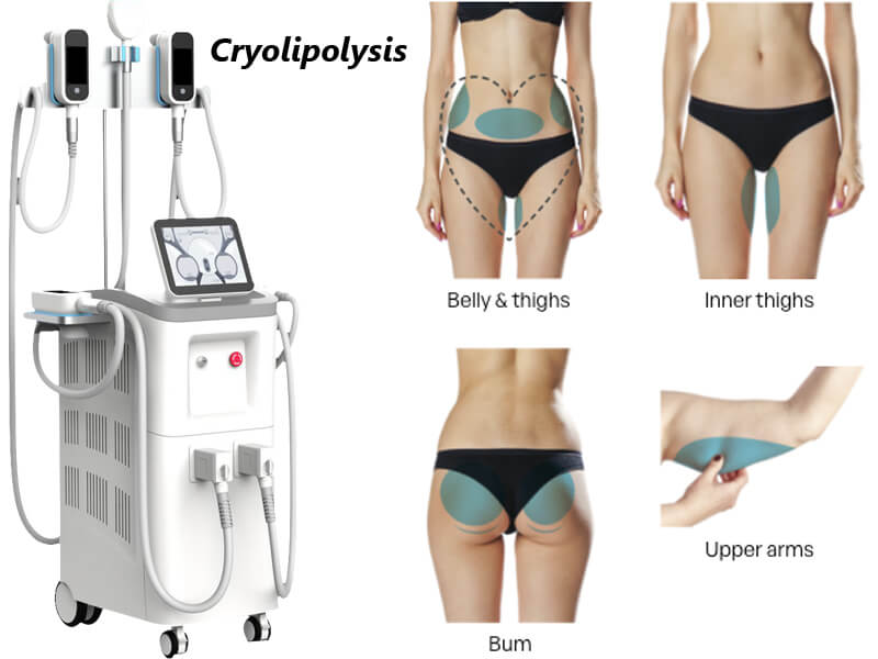 cryolipolysis machine