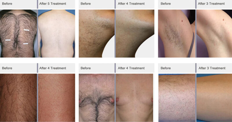 diode laser treatment