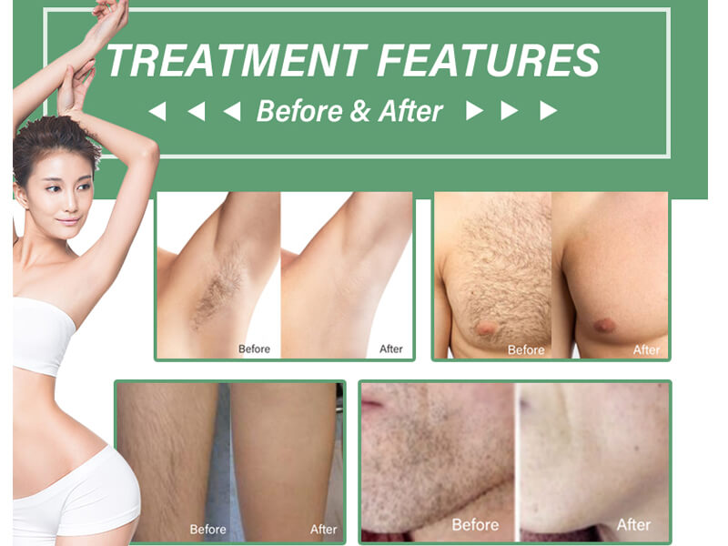 laser hair removal treatment