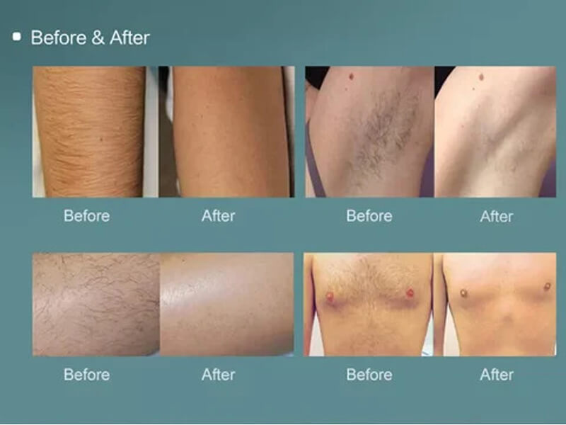 laser hair removal treatment before and after