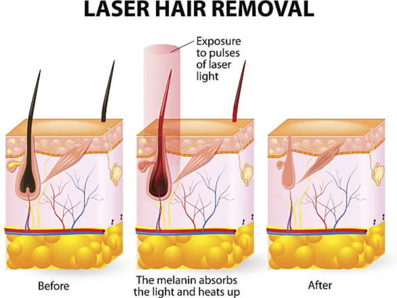 diode laser treatment