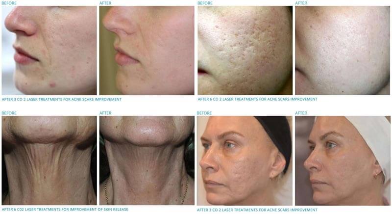 co2 fractional laser treatment