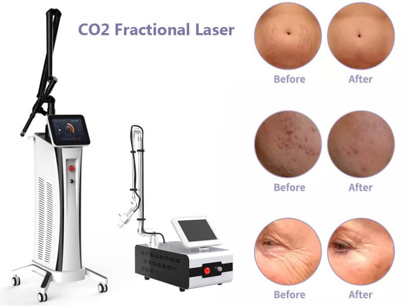 co2 fractional laser machine