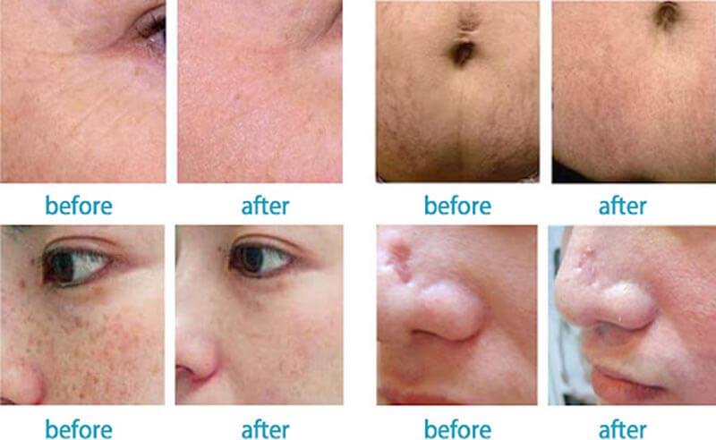 co2 laser skin resurfacing