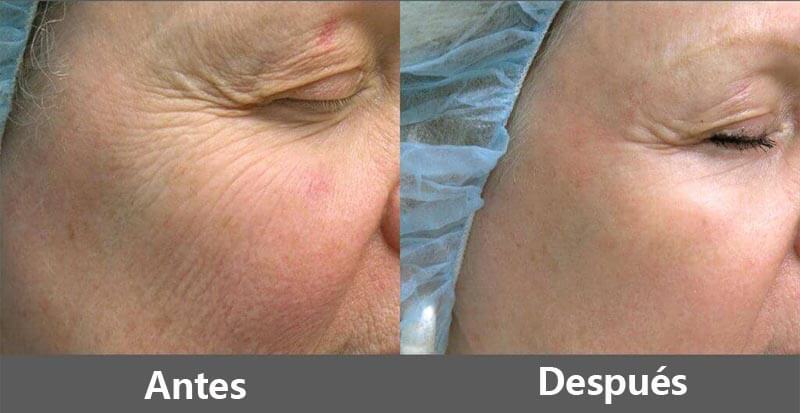 erbium laser resurfacing