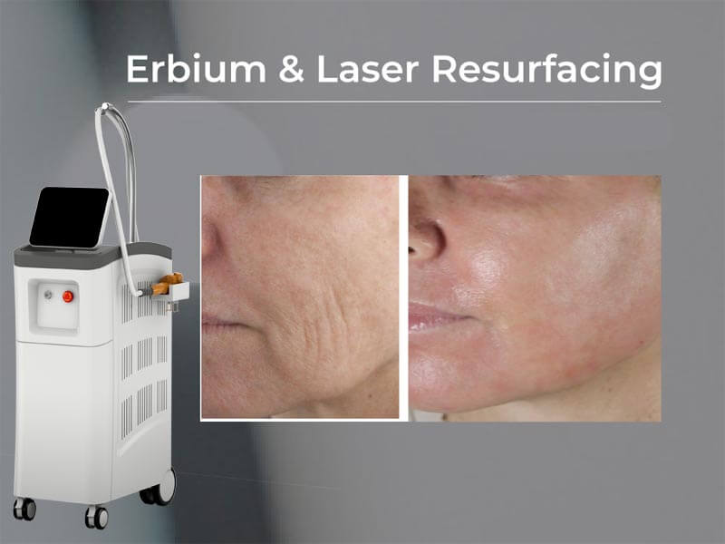 erbium laser resurfacing