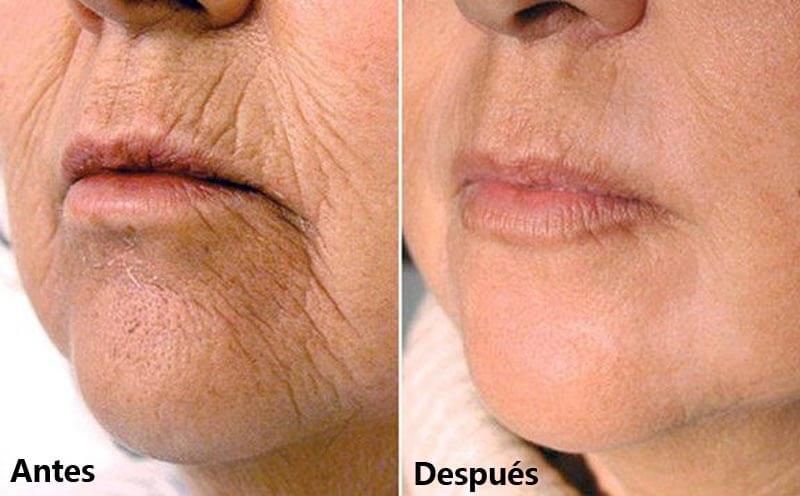 erbium laser resurfacing