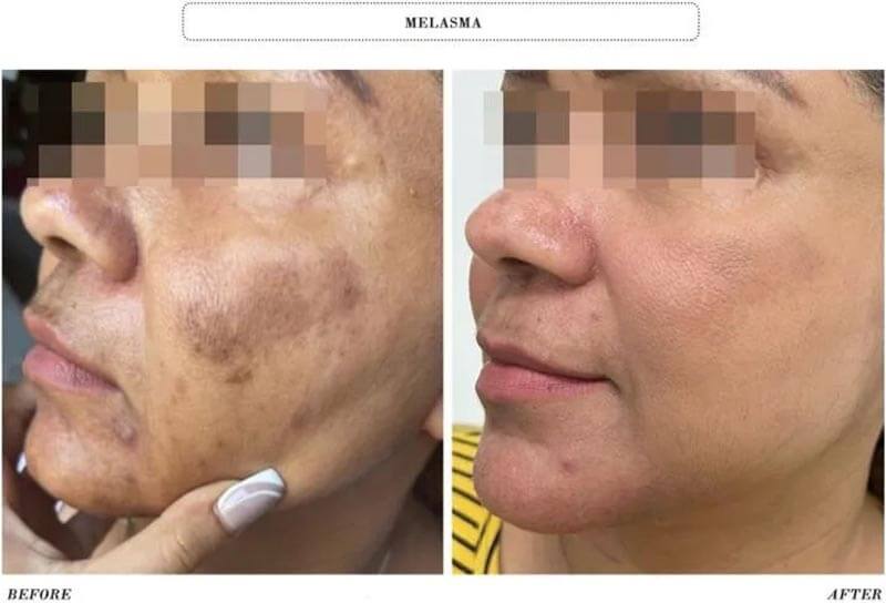 picosecond laser treatment before and after