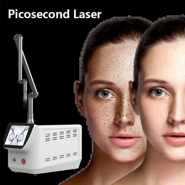 Láser de picosegundos para eliminar o minimizar el melasma