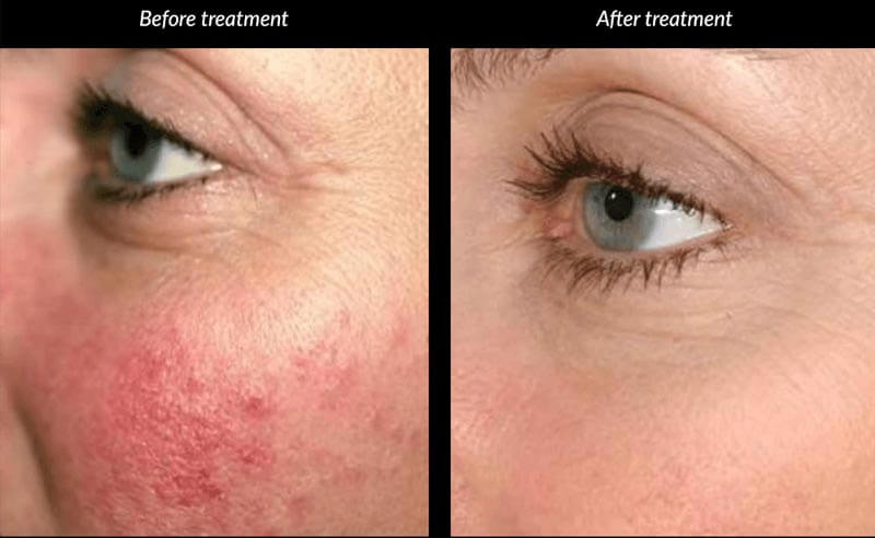 thulium laser treatment before and after