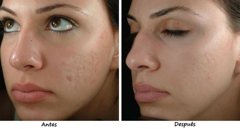 thulium laser treatment before and after