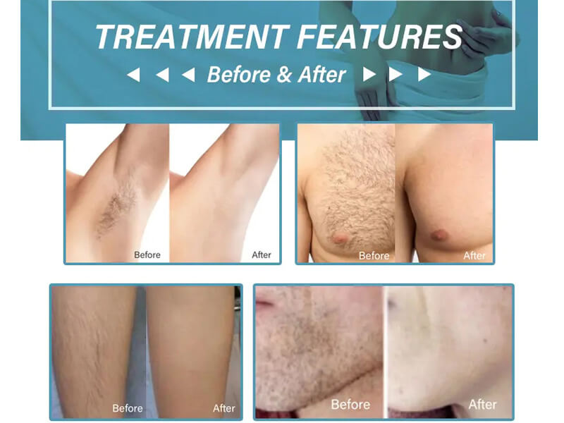 laser hair removal treatment