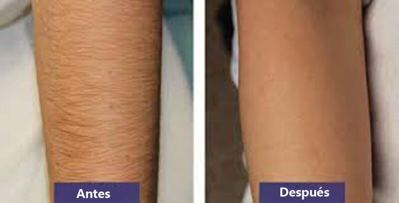 laser hair removal treatment