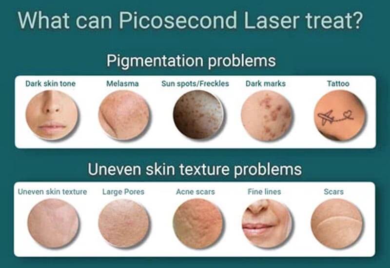 picosecond laser treatment