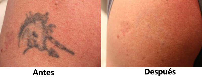 picosecond laser treatment