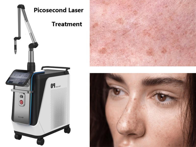 picosecond laser machine