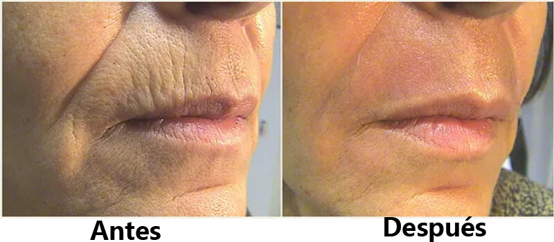 co2 laser skin resurfacing