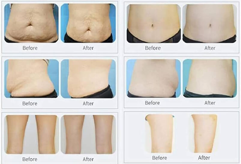 cryolipolysis treatment