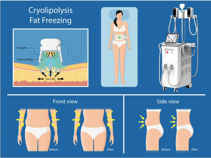 cryolipolysis fat freezing machine