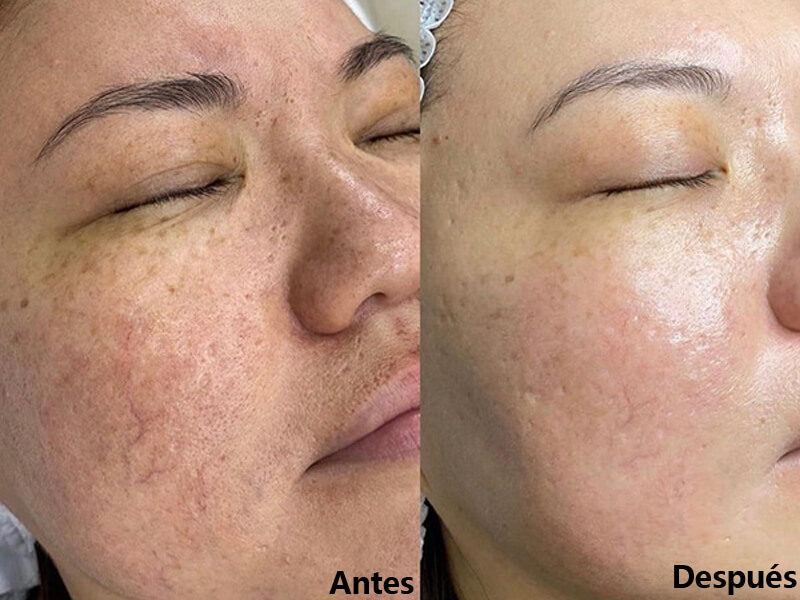 erbium laser skin resurfacing