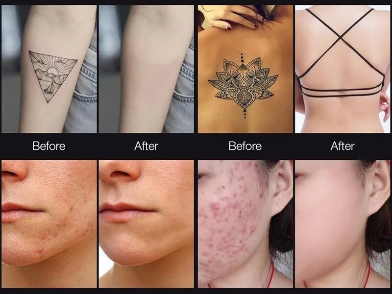 picosecond laser treatment before and after