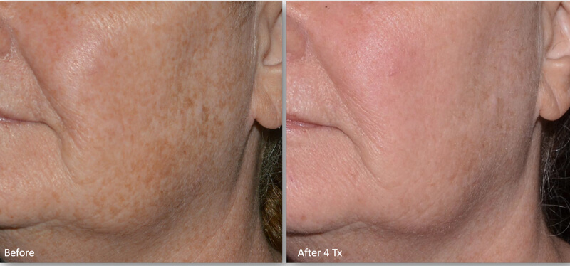 thulium laser treatment