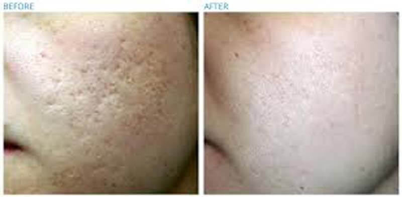 co2 laser treatment