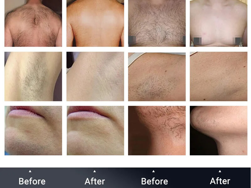 diode laser hair removal treatment