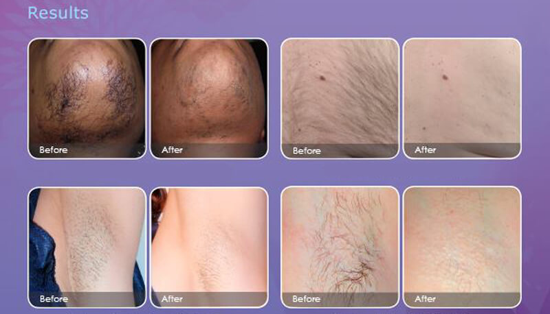 laser hair removal treatment