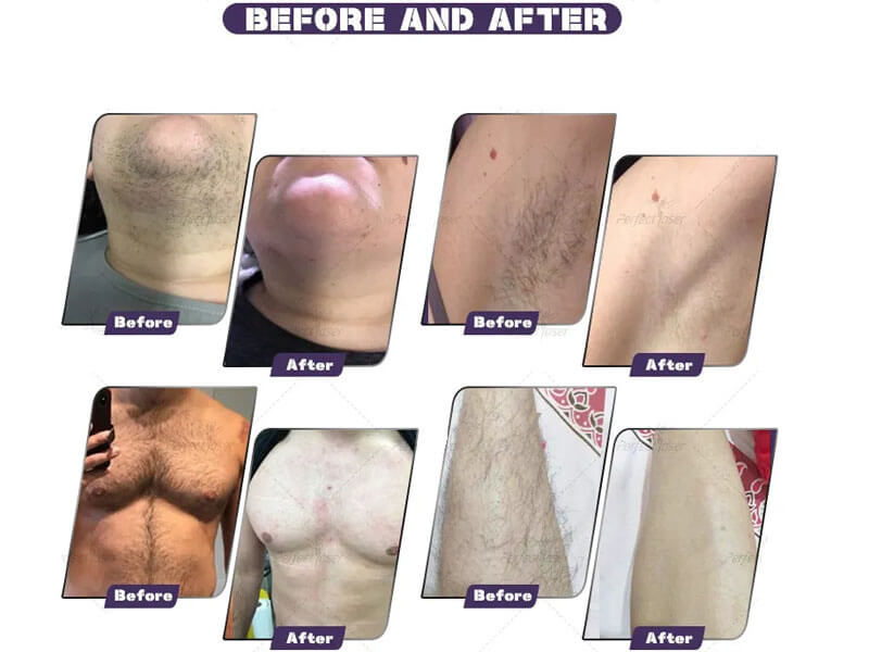 diode laser hair removal treatment before and after