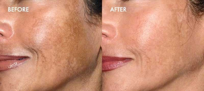 picosecond laser treatment