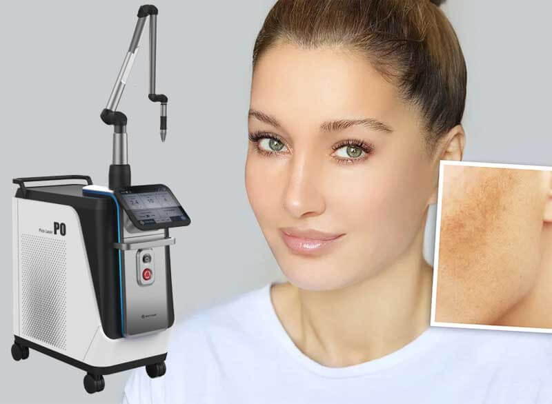 picosecond laser tattoo removal machine