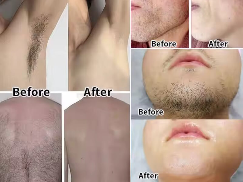 laser hair removal treatment