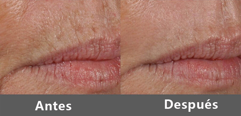 erbium laser treatment