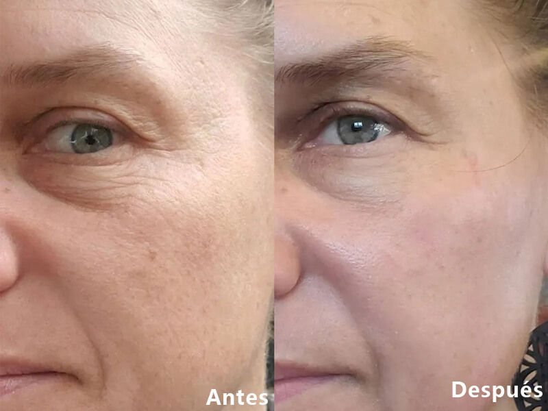 erbium laser resurfacing
