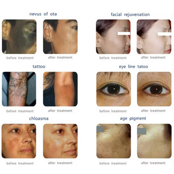 picosecond laser tattoo removal machine