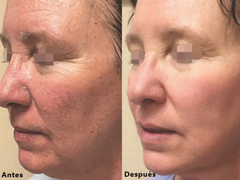 erbium laser resurfacing