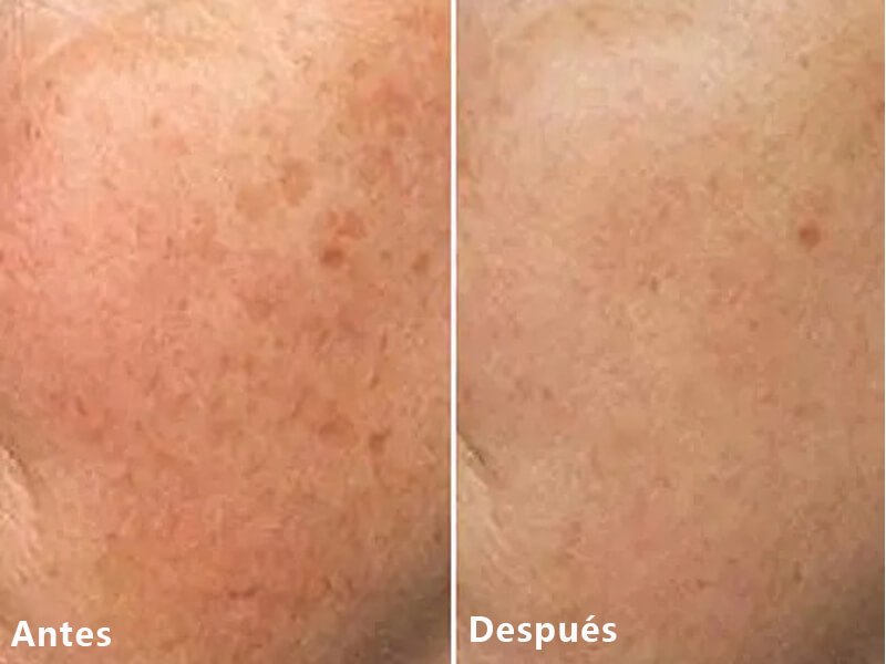 thulium laser treatment