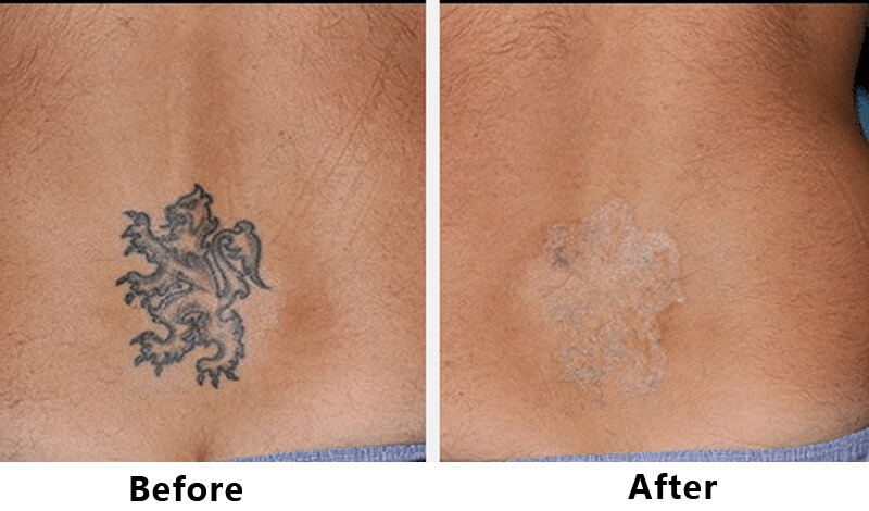 picosecond laser treatment