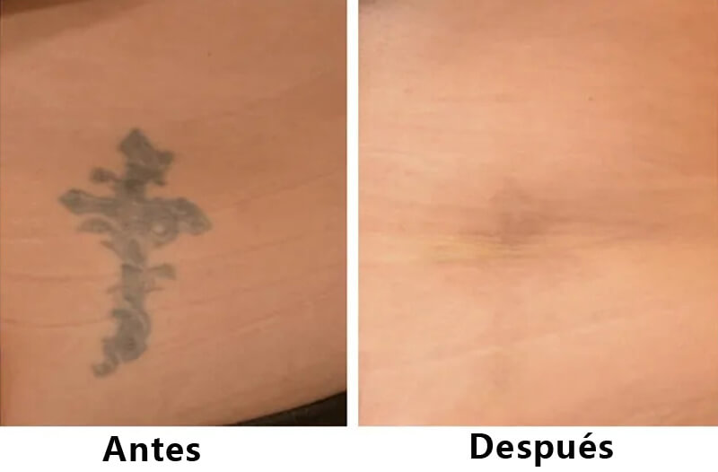 picosecond laser treatment
