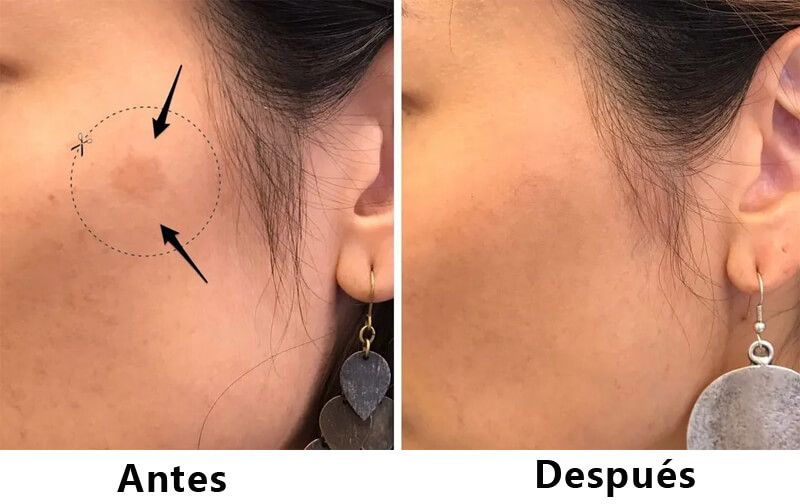 picosecond laser treatment before and after
