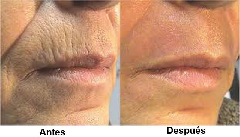 co2 laser resurfacing