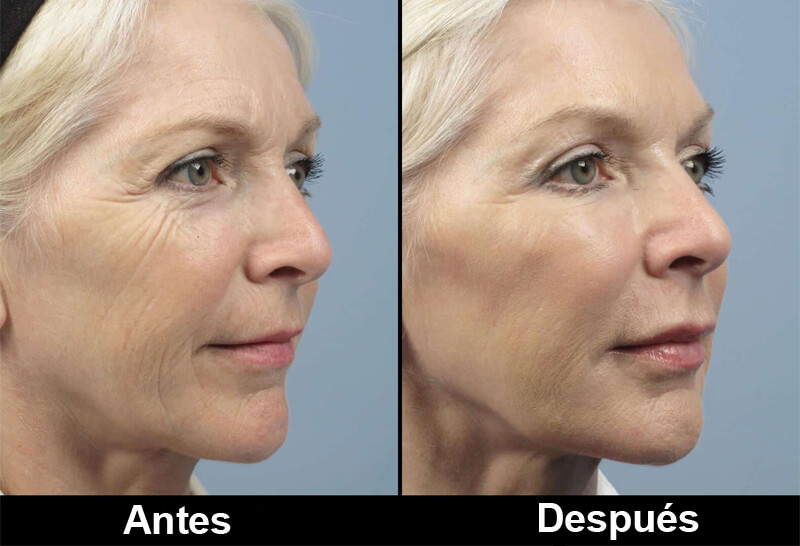 co2 laser treatment