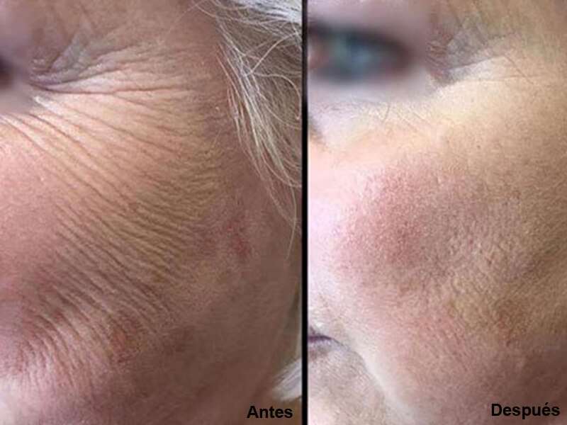erbium laser treatment